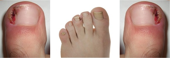 What causes an ingrown toenail?