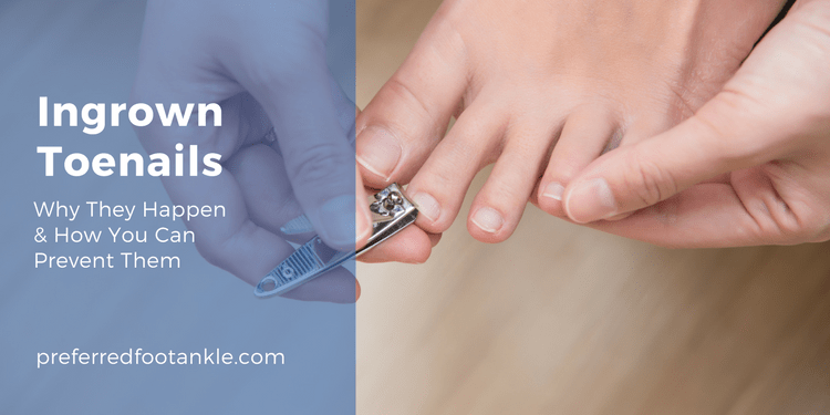 Ingrown Toenails