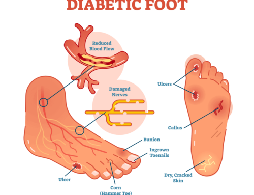 Diabetic Foot Care Tips