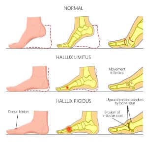Hallux Rigidus
