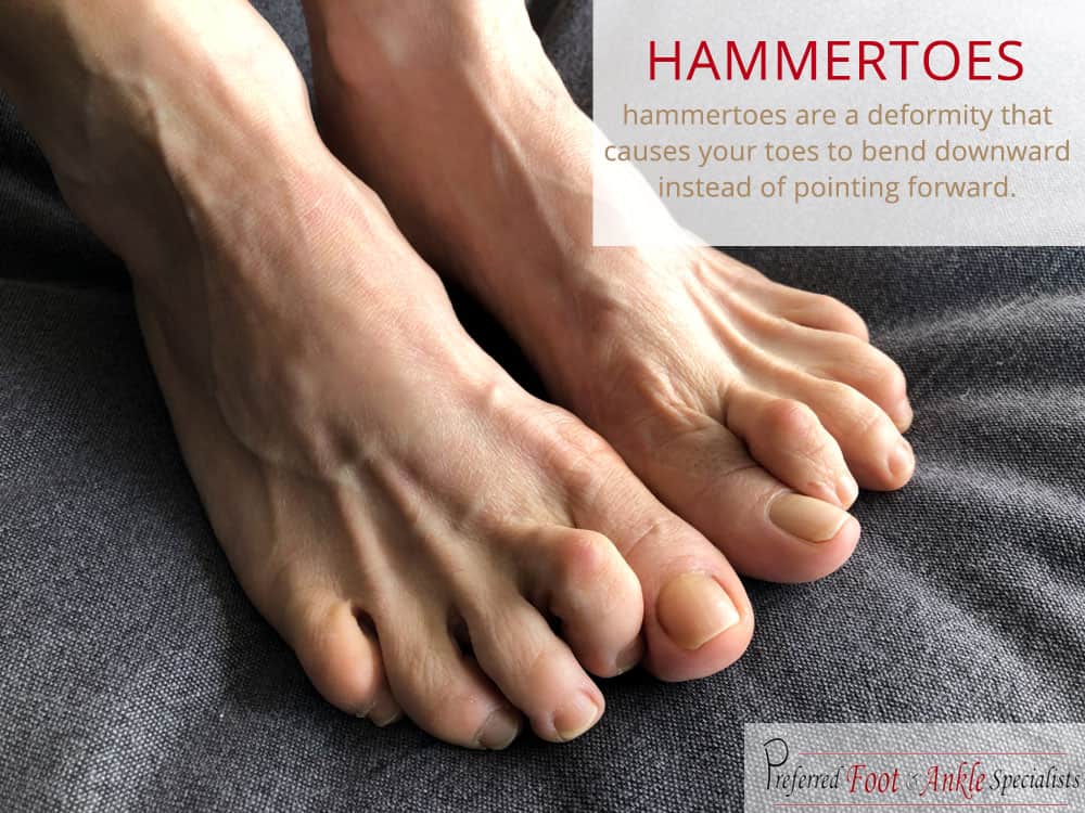 Hammertoes - Diagnosis & Treatment