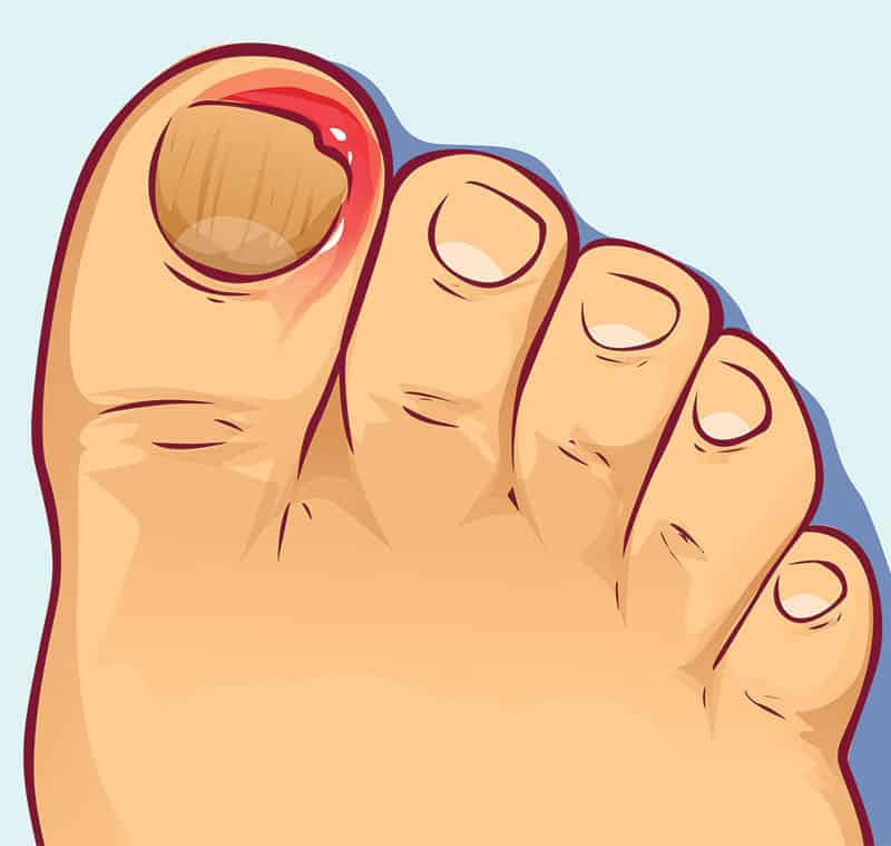 Popular Podiatry Myths